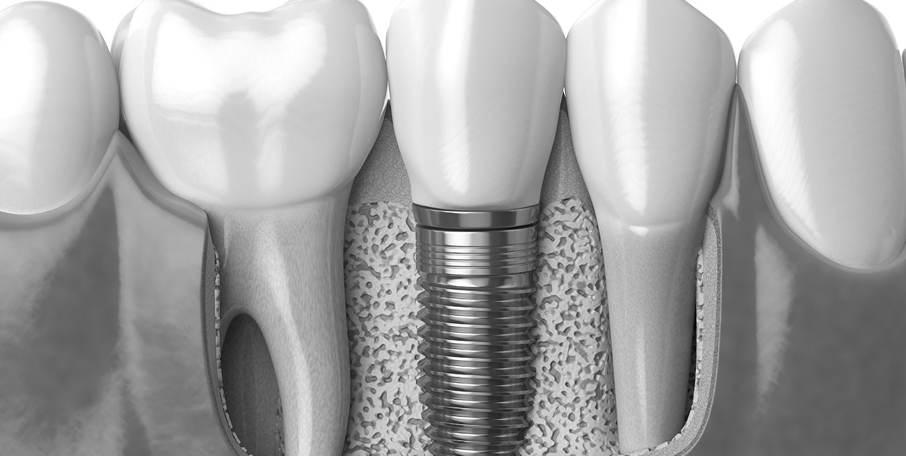 implant zuba, cena implanta, implant zuba, implant zuba cena, zubni implant, zubni implant cena, implanti za zube, ugradjivanje implanta zuba, koliko kosta implant zuba, dentalni implanti. cena implanta jednog zuba, implant zuba cena novi sad, implant zuba cijena, implant zubi, zub implant, cena implanta po zubu